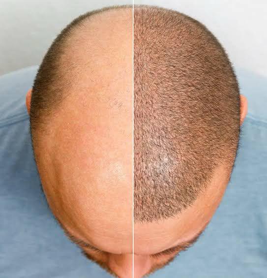 Hair Transplant